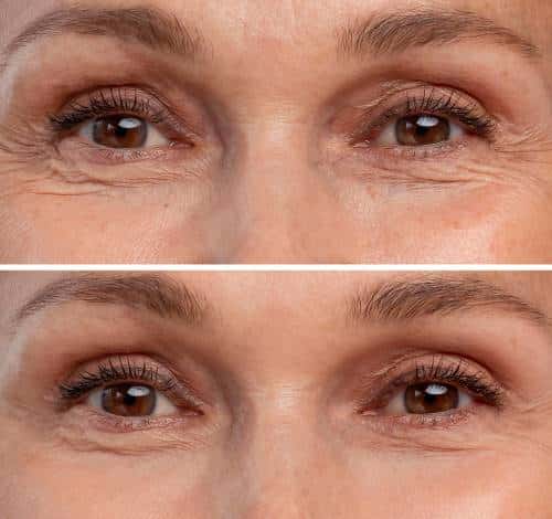 blefaroplastia